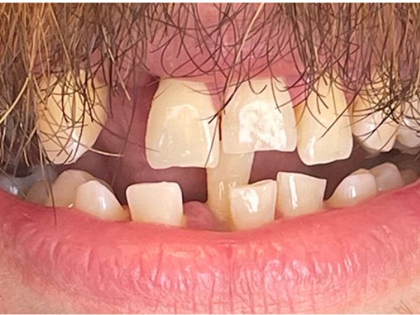 Before removable dentures treatment